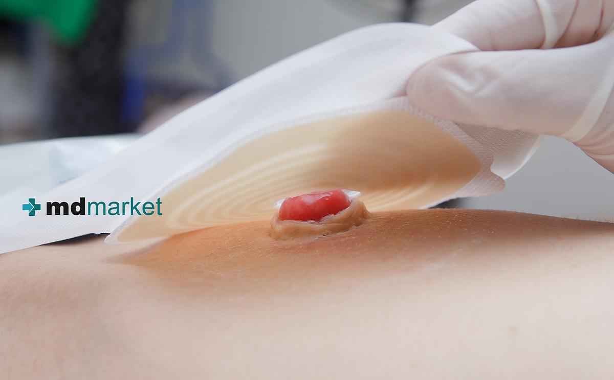 Cambio de bolsa de ostomía o sistema de recolección de una pieza: Mdmarket