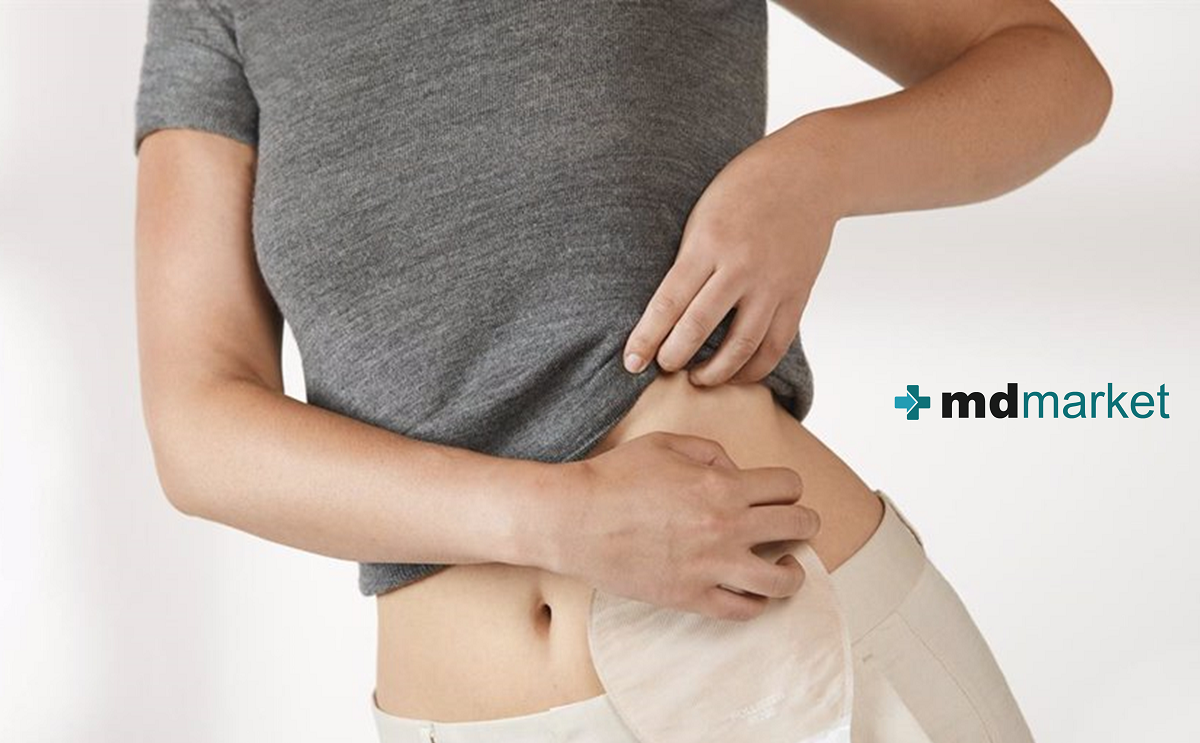 Consejos para prevenir fugas de tu bolsa de ostomía: Mdmarket