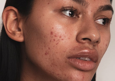 Post-inflammatory Hyperpigmentation