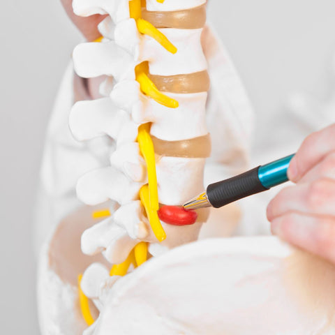 a model spine showing a spinal disc protruding on the side