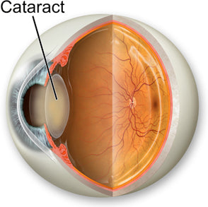 cataract image