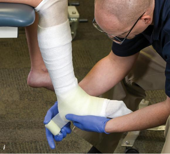 Methods for immobilizing the fractured foot and ankle – Human Kinetics