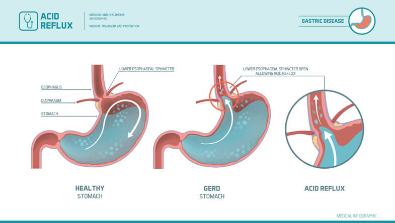 GERD condition infographic