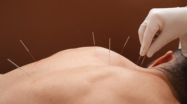 man getting acupunture treatment