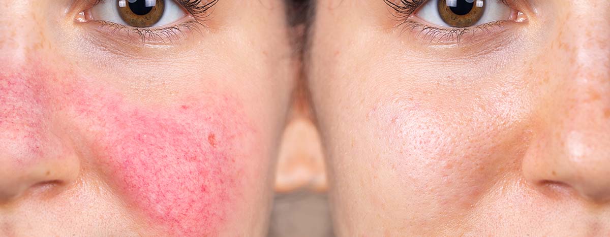 AMPERNA Hilfe bei Akne und Rosacea