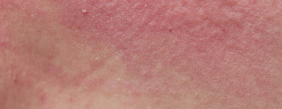 AMPERNA Empfindliche vs. sensibilisierte Haut
