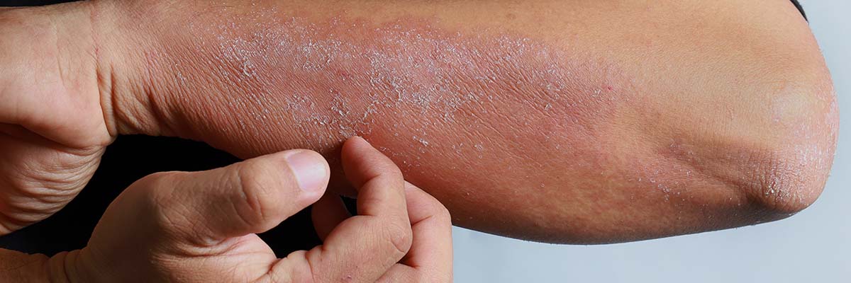 AMPERNA® Eczema Tips