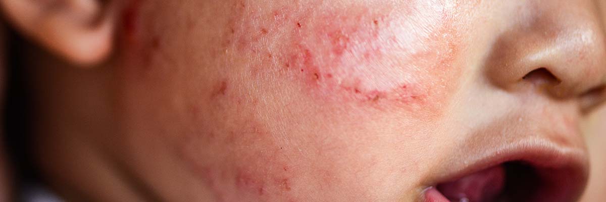 AMPERNA® Eczema Tips