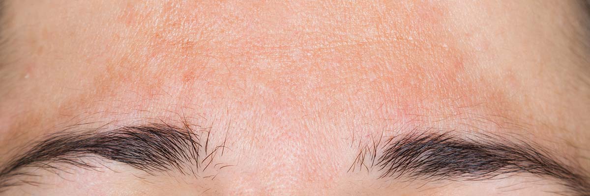 Pigmentation on forehead