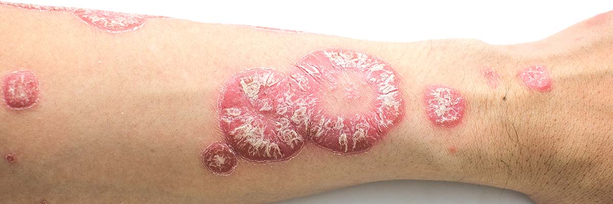 AMPERNA® Psoriasis-Behandlung