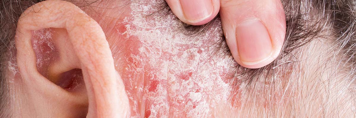 AMPERNA® Psoriasis-Behandlung