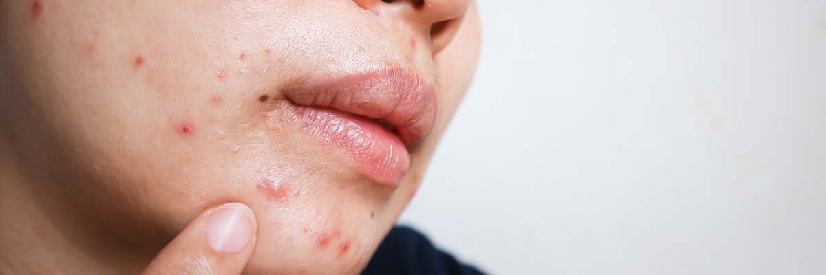 Inflammatory Acne