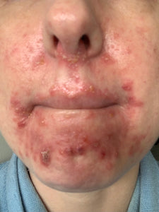 口周囲皮膚炎の結果
