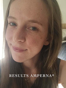 Acne Skin Care | RESULTS AMPERNA