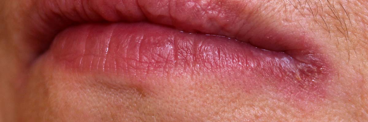 AMPERNA skin concerns on and around the mouth