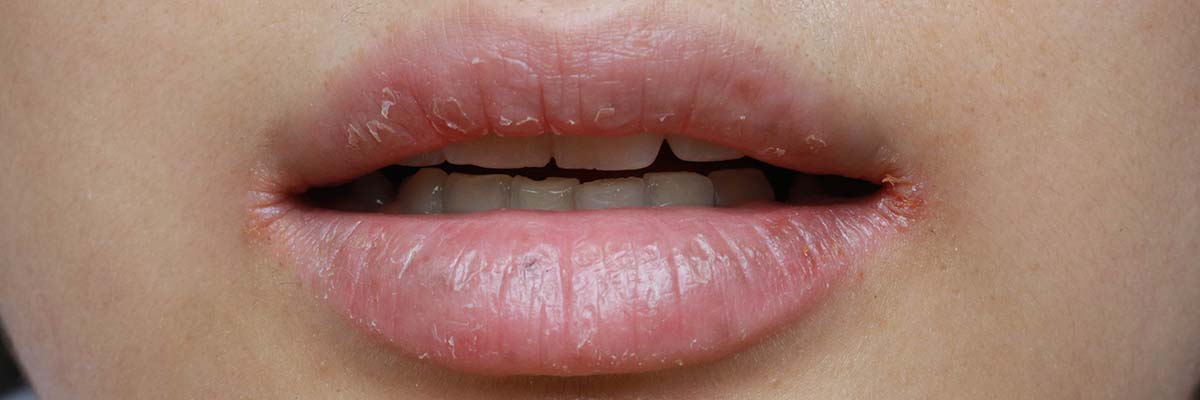 AMPERNA skin concerns on and around the mouth