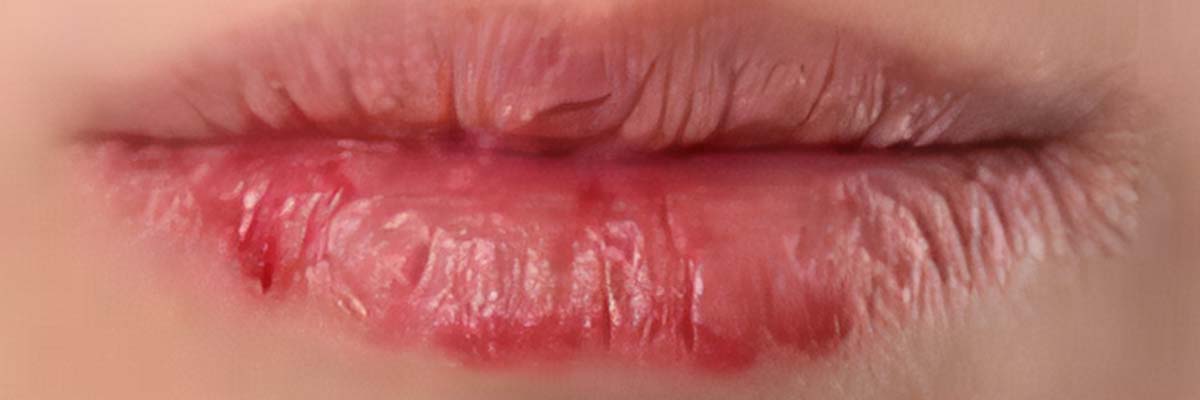 AMPERNA skin concerns on and around the mouth