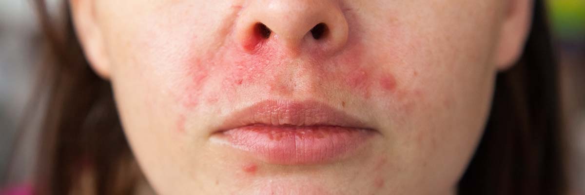 AMPERNA® Perioral Dermatitis Dos Donts