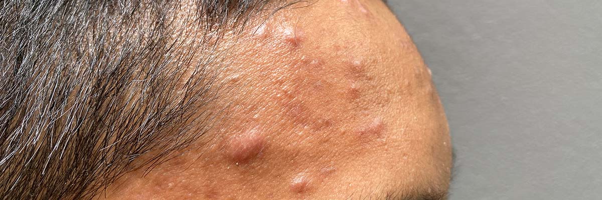 AMPERNA® Accutane Side Effects