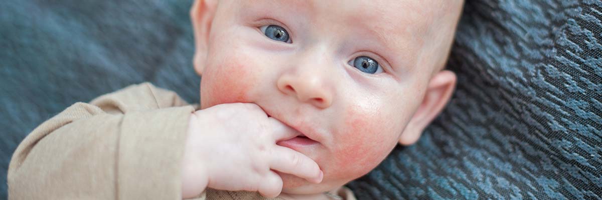 AMPERNA Dermatitis in Children