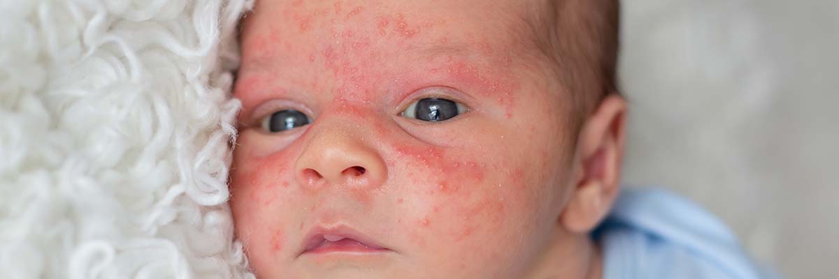 AMPERNA® Eczema Dos and Don'ts