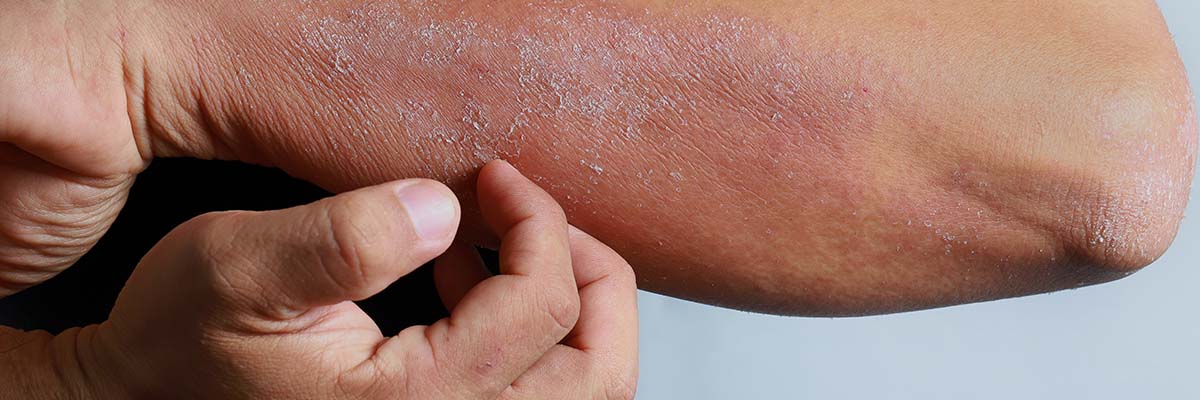 AMPERNA® Eczema Dos and Don'ts