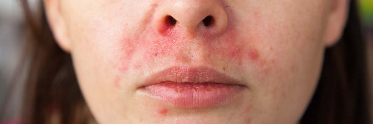 AMPERNA® Perioral Dermatitis