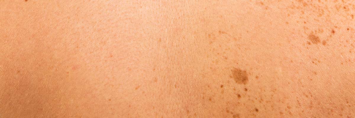 AMPERNA® Hyperpigmentation Dos and Don'ts