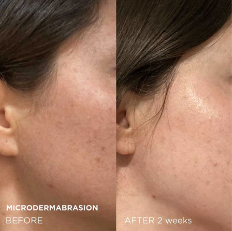 Microdermabrasion Before and After