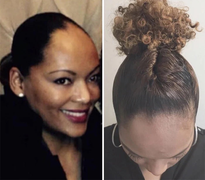 Embracing Natural Beauty: The Unique Struggles and Triumphs of Black Women  with Alopecia - The Source