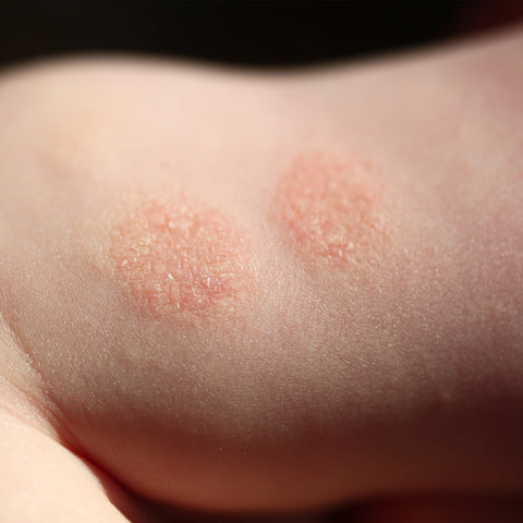 Nummular eczema typically presents itself as a circular rash.