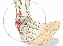 A good rule of thumb for someone not trained to diagnose injuries is if the injured person cannot put any weight on the injured leg immediately after the injury, an X-ray or, at least further investigation, may be warranted to rule out fracture.