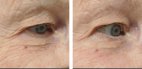 TempSure Envi Before After Images - Accent on Beauty