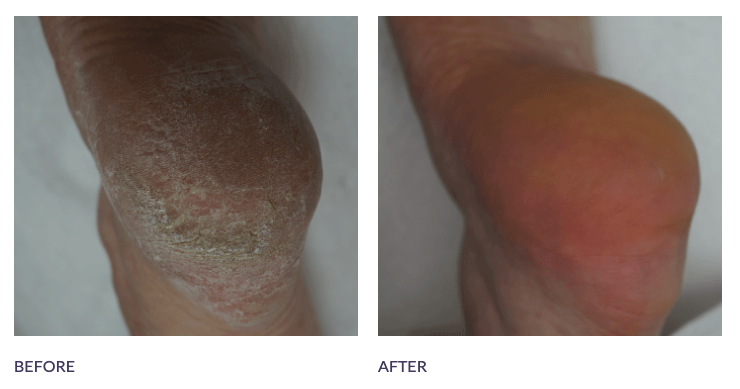 Footlogix Before and After Callus Heel