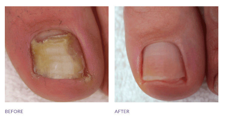 Footlogix Nail Tincture 