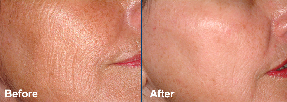 Fractional Laser Treatments Before and After Accent on Beauty
