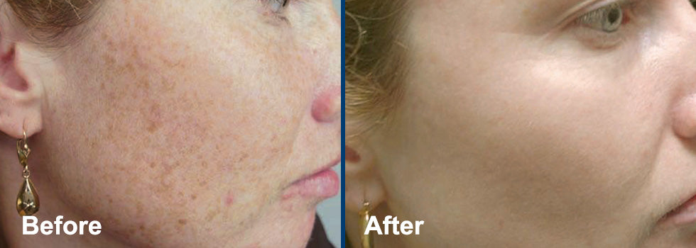 IPL Skin Renewal Before and After - Accent on Beauty