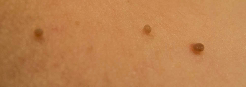 Accent on Beauty Skin Tag Removal