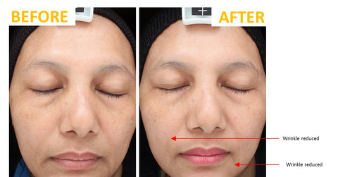 Nigella Therapy clinicals: before after photo sample that shows reduced wrinkles