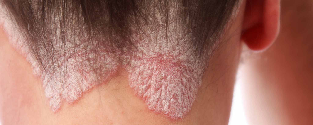 Get Scalp Psoriasis Under Control Clinicalposters