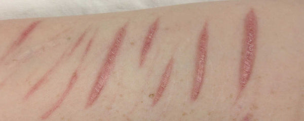 Self-injury arm cuts