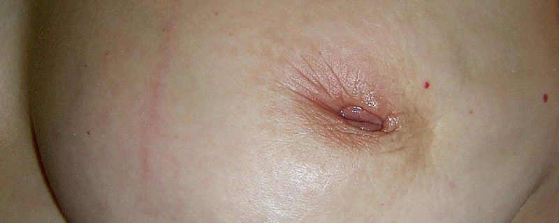 Cancerous inverted nipple
