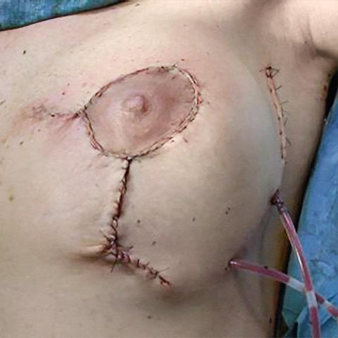 Post-Op Nipple-Sparing Mastectomy