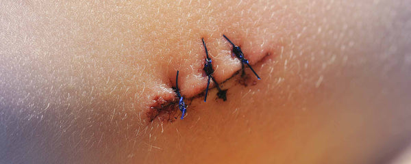 Lipoma stitches