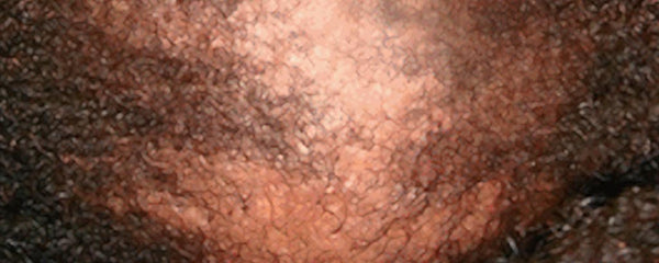 Central Centrifugal Cicatricial Alopecia