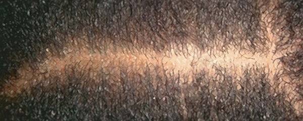 Genetic Central Centrifugal Cicatricial Alopecia