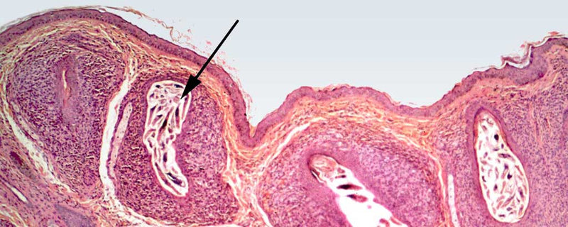 Demodicosis proliferation within hair follicle