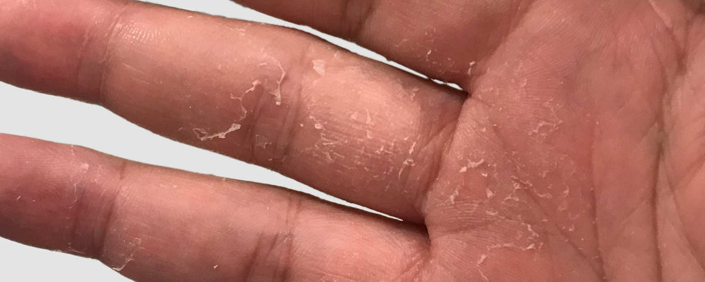 Diclofenac hand flaking