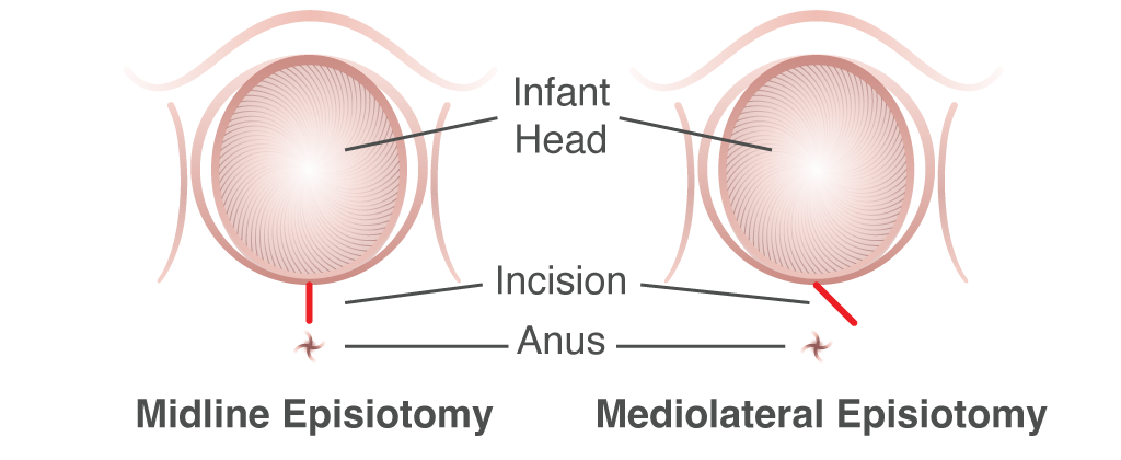 Episiotomy comparison