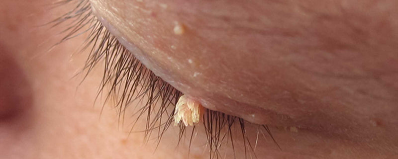 Eyelid warts